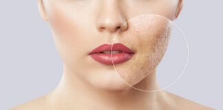 Blizny po trądziku widoczne na twarzy młodej kobiety. Meta tytuł: Usuwanie blizn potrądzikowych – jak wygląda?